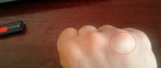 Выбил костяшку на кулаке