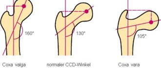 Двусторонняя соха Valgusa.