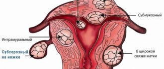 Миома, жидкость в миоматозном узле