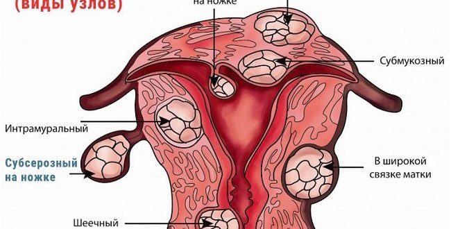 Миома, жидкость в миоматозном узле