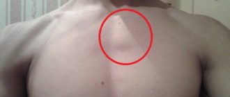 Выпирает бугорок выше груди