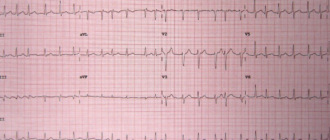 Экг с ненормальным ритмом