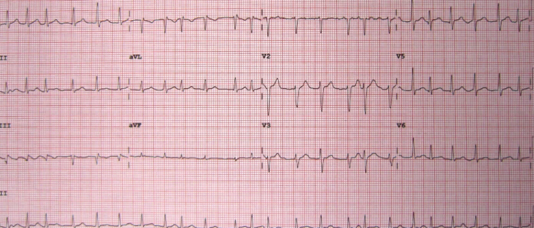 Экг с ненормальным ритмом