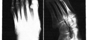 Восстановление после переломовывиха Лисфранка