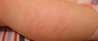 Высокая температура и красное пятно на попе у ребенка