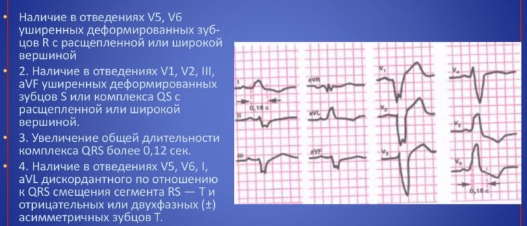 Можно ли заниматься спортом с блокадой ножкой Гиса