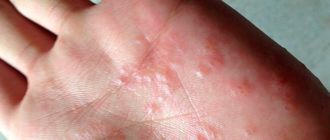Водянистые пузыри у ребенка, переходящие в раны
