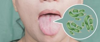 На поверхности языка грибок Candida, лептотрикс