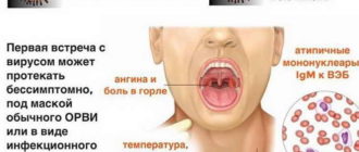 Вирус Эпштейн-Барра