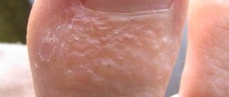 Водянистые пузырьки на ногах и руках
