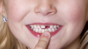 Чем можно заменить выпавший зуб?