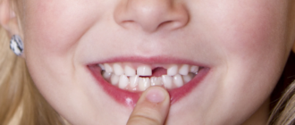 Чем можно заменить выпавший зуб?
