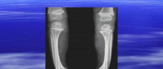 Деформация большеберцовой кости