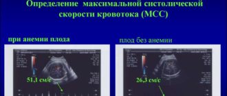Нарушения кровотока 1а. Низкорезистентный кровоток в СМА
