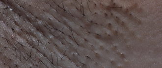 Воспаление после выдавления гранулы фордайса