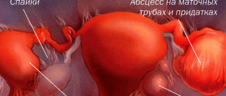 Воспаление яичников при миоме лечение