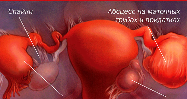 Воспаление яичников при миоме лечение