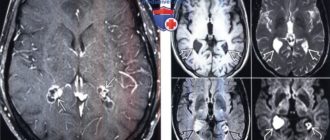 Двусторонние кисты хороидных сплетений боковых желудочков мозга