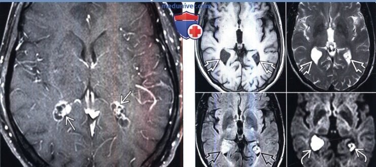 Двусторонние кисты хороидных сплетений боковых желудочков мозга