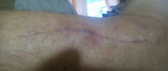 Волдыри возле раны после операции на голеностопе