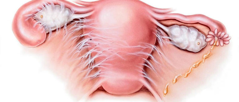 Всегда ли спайки после хламидиоза?