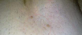 Чем удалять папилломы на мошонке