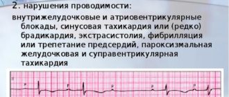 Нарушение внутрижелудочковой проводимости, синусовая брадикардия