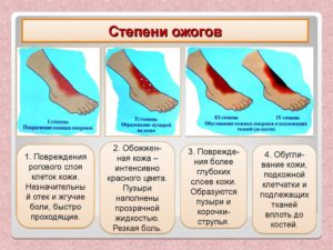 Можно ли ходить с ребёнком гулять при ожеге