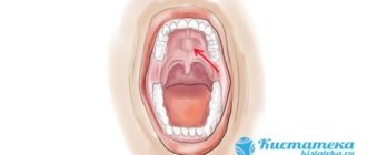 На верхнем нёбе уплотнение