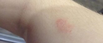 Внезапно появилась выпуклая голубая точка на руке