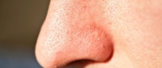 Мелкие прыщи на носу