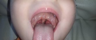 Высокая температура и красное горло строго раз в месяц