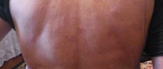 Моему отцу 80 лет, как облегчить состояние зуда кожи?