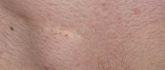 Внутренние шишечки и прыщи в паховой зоне