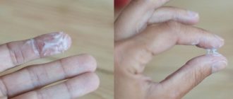 Выделения с резким запахом после Лактожиналь