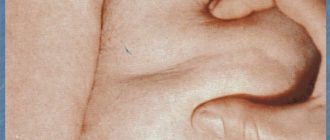 Впадина на молочной железе