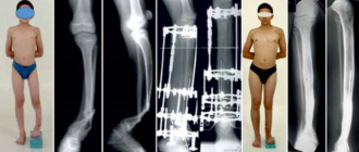 Вражденный ложный сустав латентная форма