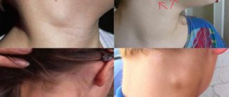 Воспаление лимфоузлов при беременности