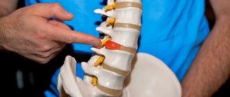 Межпозвоночная грыжа