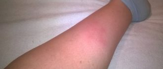 Что-то появилось на ноге