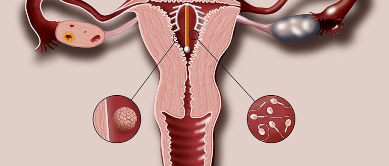 Внутриматочная спираль. Если ходить долго. Какие последствия будут?