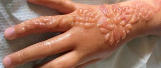 Вылезли гнойные волдыри после тату