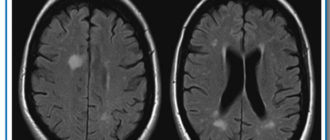 Мелкоочаговые поражения белого вещества головного мозга