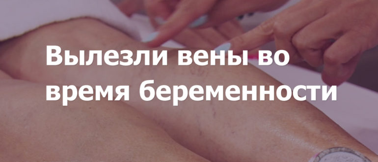 Вылезли вены при беременности