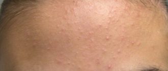 Мелкие прыщи на лице