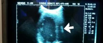 УЗИ и кардиостимулятор