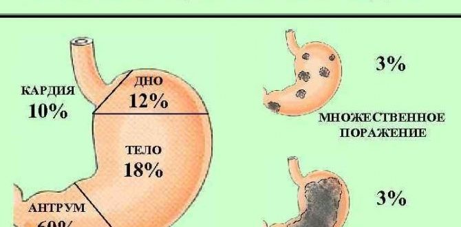 Может ли быстро развиться рак желудка?