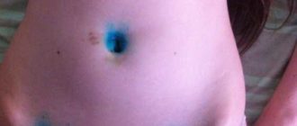 Визанна и мой цикл после лапароскопии