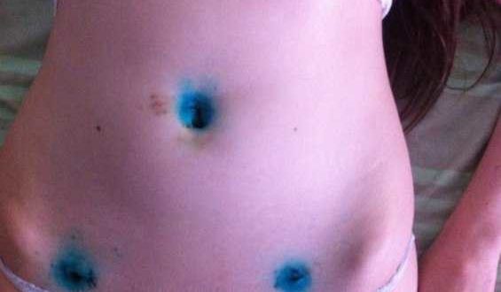 Визанна и мой цикл после лапароскопии