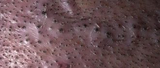 Воспаление волосяных луковиц